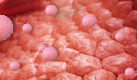 A depiction of inflamed tissue with few pink cells